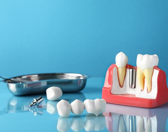 A dental bridge and implant parts set against a blue background