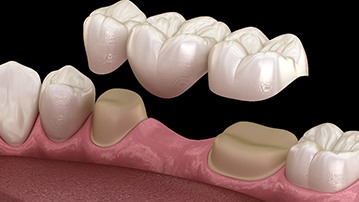A 3D illustration of a dental bridge