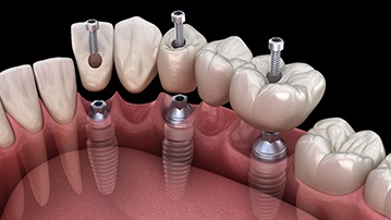 A 3D illustration of an implant bridge