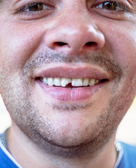Closeup of damaged smile before restorative dentistry treatment