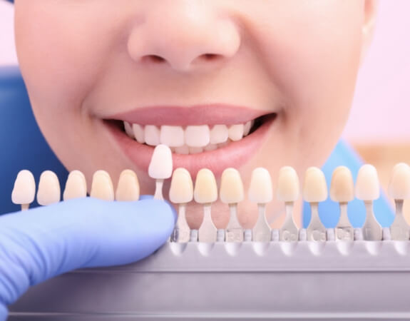 Smile compared to tooth colored filling shade options