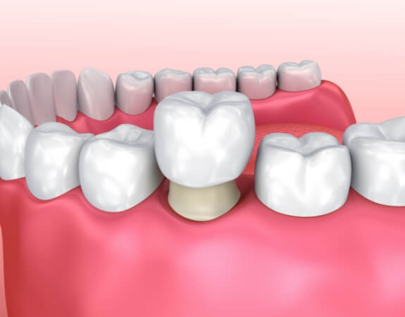 Animated smile during dental crown placement