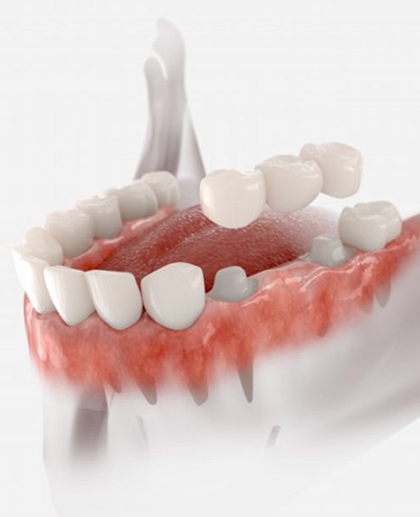 Dental crowns support dental bridge