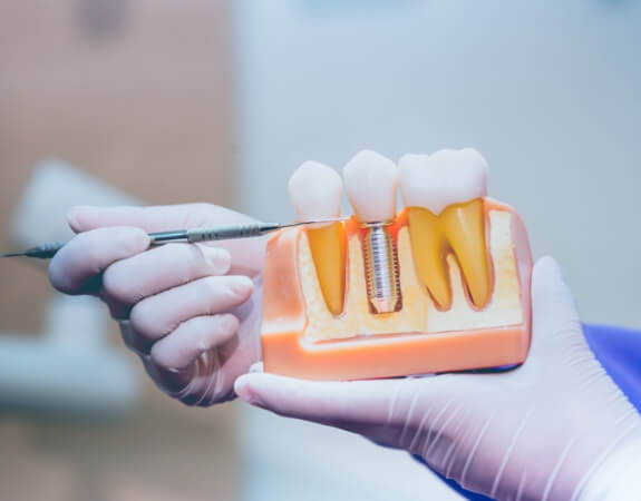 Dentist using a smile model to explain the four step dental implant process
