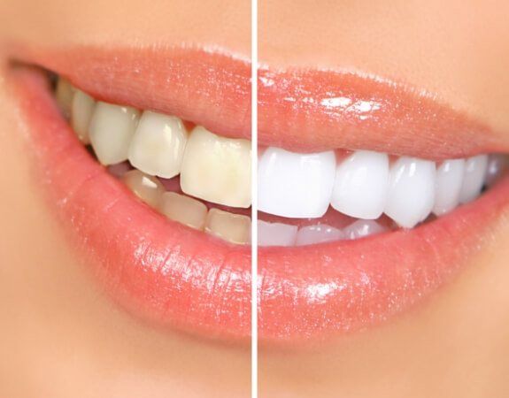 Smile before and after teeth whitening