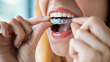 Closeup of woman placing Invisalign aligner on top teeth