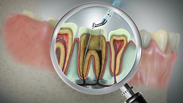 Illustration of a root canal