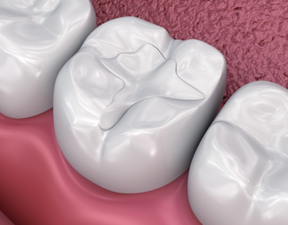 3D render of a dental filling