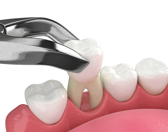 Illustration of dental forceps removing tooth