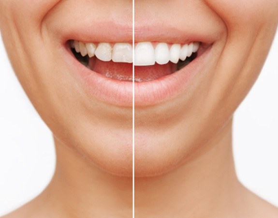A before-and-after photo of veneers in Morganville