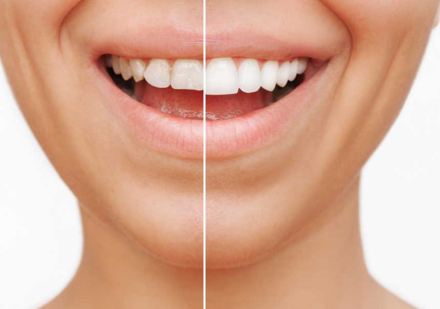 Before and after of veneers