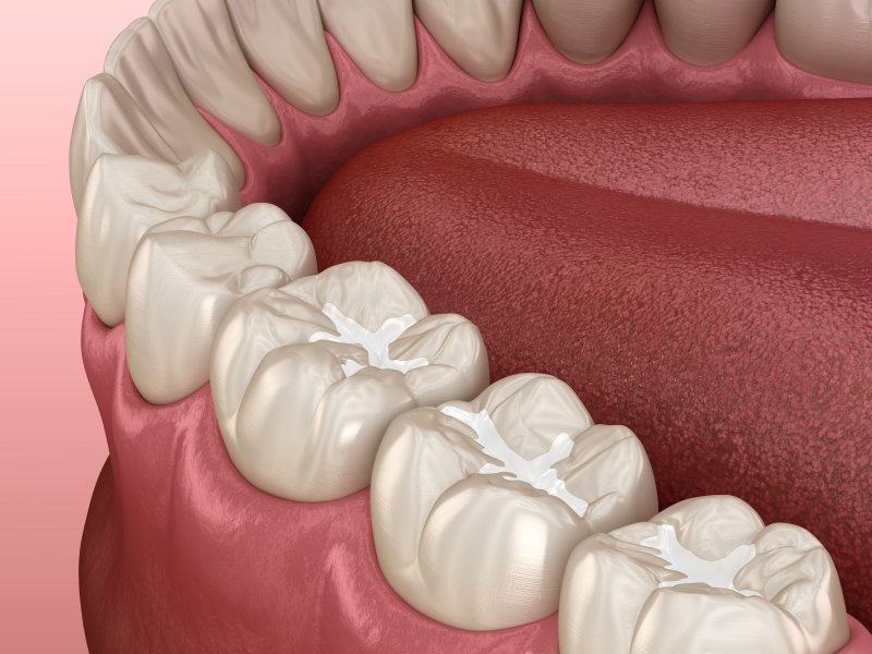digital image of tooth-colored filling